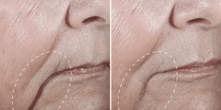 Crepey Skin Explained: What Causes It and How to Treat It Effectively