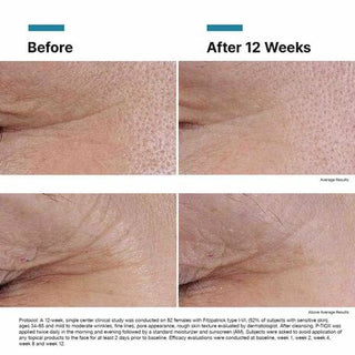 Skin Ceuticals P-Tiox Serum Results Before and After 