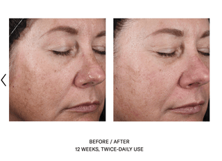 Skinbetter Alto Advanced Defense and Repair Serum before and afters. 12 weeks, twice-daily use.