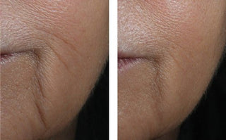 skinbetter Interfuse Intensive treatment lines before and afters of a woman's mouth. 