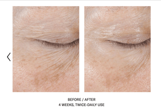Skinbetter InterFuse Treatment Cream Eye before and after. 4 weeks, twice-daily use.