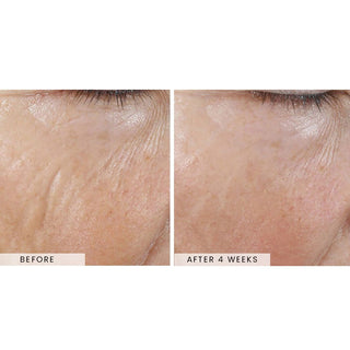 skinbetter Interfuse Intensive treatment lines before and afters of a woman's cheek. 